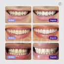Clareador Dentário - Sérum V34™ + Brinde - imagem 2